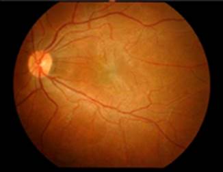 1 Fundus Photograph Of Epiretinal Membrane 1 Fundus Photograph Of Epiretinal Membrane